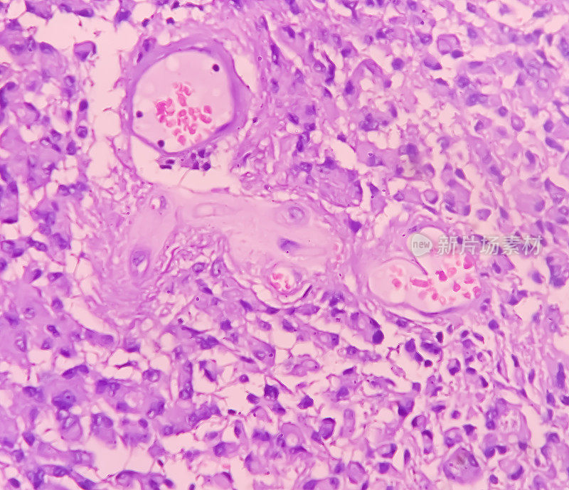 星形细胞瘤，髓内SOL (C5-D3)组织活检。显微照片显示恶性肿瘤卵圆形到细长的细胞，细胞核偏心，嗜酸性细胞。Micovascular增殖。